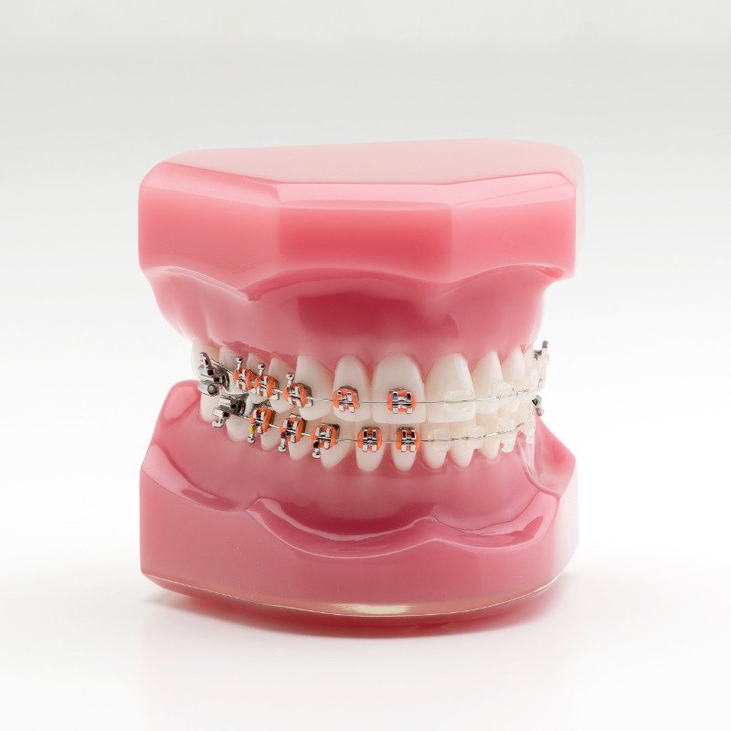 brakets 